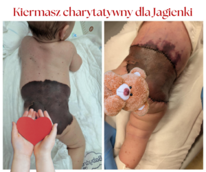plakat przedstawia 2 zdjęcia dziecka, czarne plamy na ciele, elementy delikatne zasłonięte serduszkiem i misiem, napis: Kiermasz charytatywny dla Jagienki